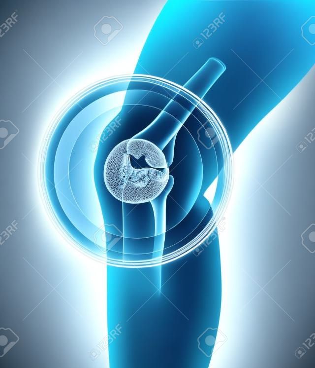 고통스러운 무릎 - 골격 엑스레이, 3D 그림 의료 개념.